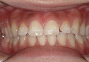 すきっ歯の治療後