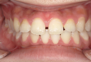 すきっ歯の治療前