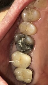 60代女性の患者。左側上顎第一大臼歯のクラック(ヒビ)および変色の画像