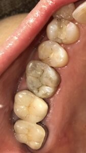 ダイレクトボンディングでの術後画像