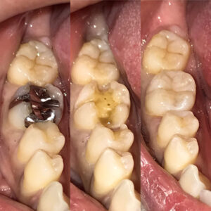 ダイレクトボンディング イメージ画像2