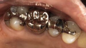 術前:左側上顎第一・第二大臼歯の画像