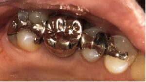 銀歯をダイレクトボンディングで治療前