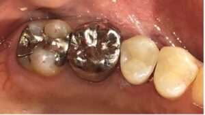 銀歯をダイレクトボンディングで治療後