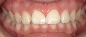 10代後半の女性 すきっぱ治療後