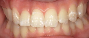20代女性 変色した歯の画像 術後