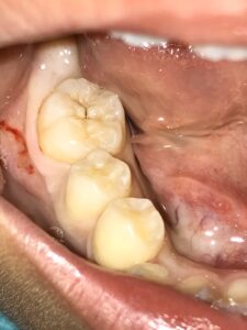 右下の奥歯の虫歯画像