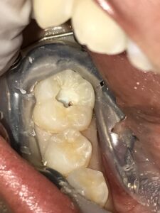 虫歯の奥の歯の神経