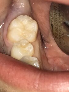 虫歯の術後写真