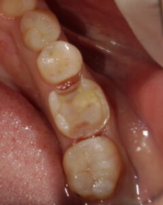 セラミック装着前