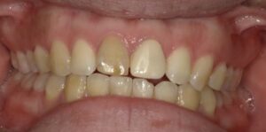 灰色に変色している歯の症例