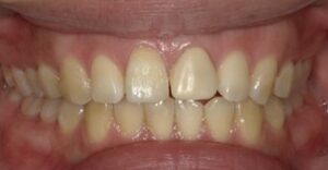 ウォーキングブリーチで治療後の歯-その2