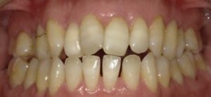 ウォーキングブリーチで治療後の歯-その1