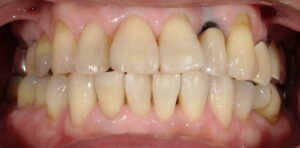 右下二番目の歯の変色-術後