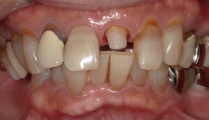 患者さん2:前歯治療術前