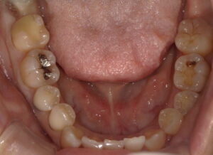 審美歯科治療-前