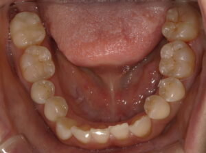 審美歯科治療-後