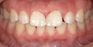 前歯の左右の側切歯の近心の空隙