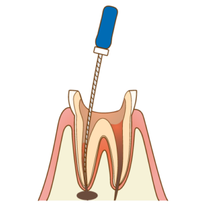 神経を細い器具で取り除く画像