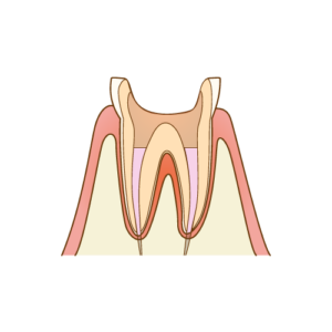 削った歯に薬を注入する画像