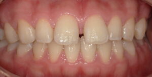 術前:上顎中切歯間にすきっ歯の画像