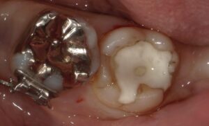 銀歯が取れた患者さんの応急処置-画像