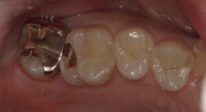 虫歯部分を取りきった画像