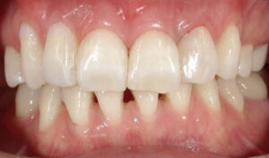 術後、ブラックトライアングルが目立たなくなった画像