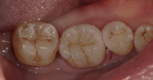 術後:銀歯が白くなった画像