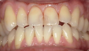 術前：上顎中切歯の間に古いCR充填の画像