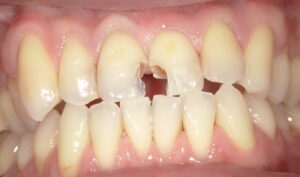 術中：古いCRおよび虫歯を除去した画像