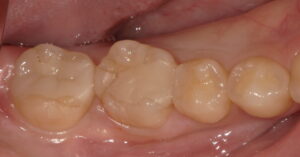 術前:セラミックの破折が認められる画像