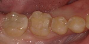 術中:セラミックを除去した画像