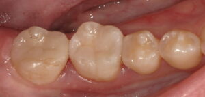 術後:ダイレクトボンディングで修復した画像