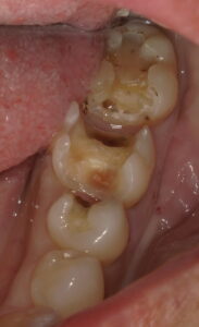 術中:銀歯を外したら虫歯が出てきたので除去