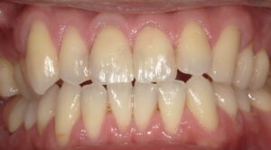 術後：詰め物の色が少し浮いて、歯と詰め物の境目がわかってしまう