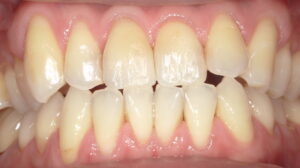 再充填後：境目はわからなくなり、自然な仕上がり