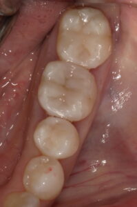 2回目治療後:きれいに修復