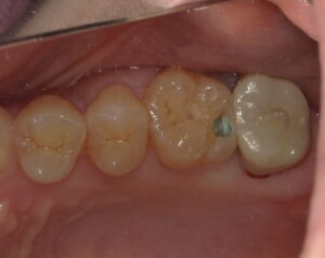 虫歯箇所を青い液で染め出した画像