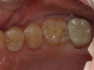 虫歯を全て除去した画像