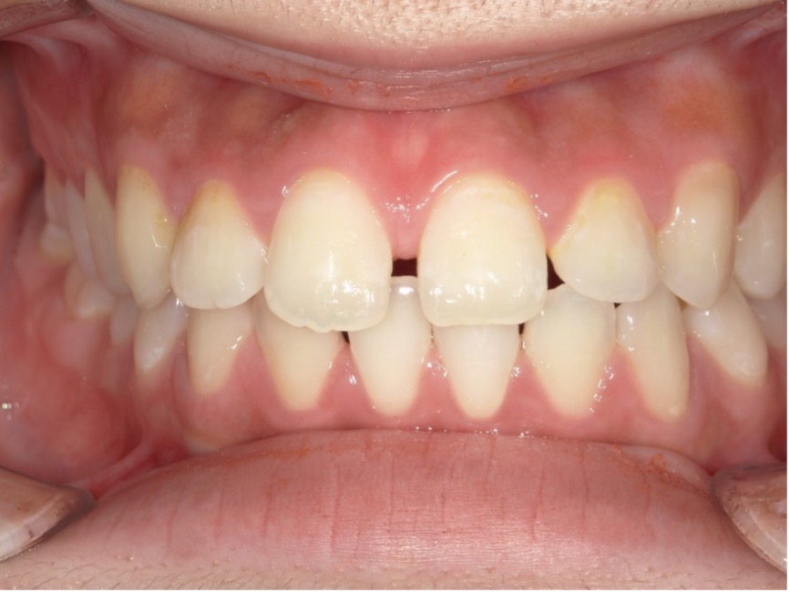 ダイレクトボンディング症例