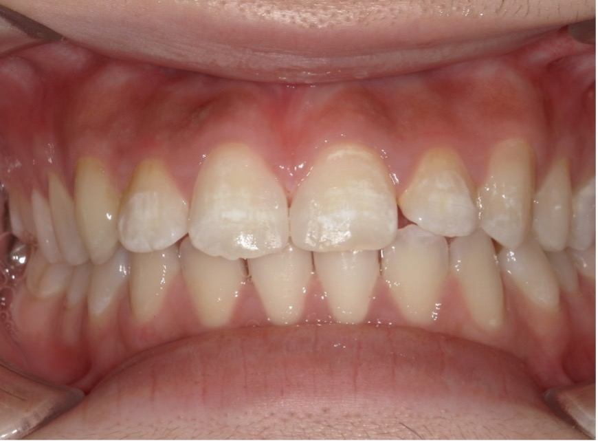 ダイレクトボンディング症例