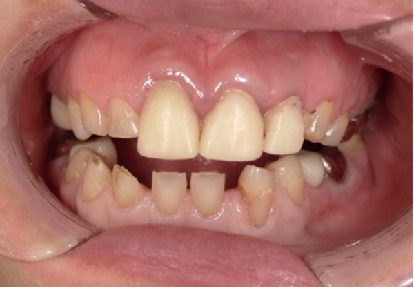 ダイレクトボンディング症例