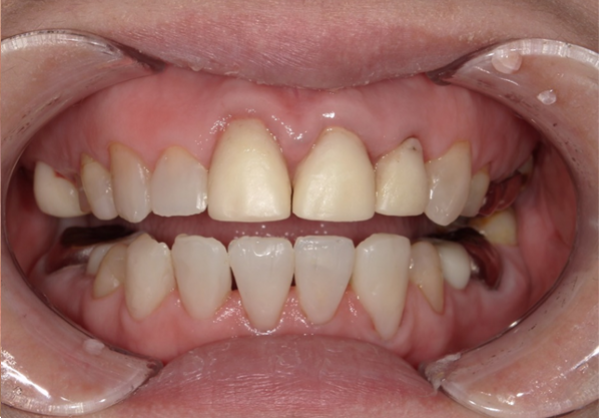 ダイレクトボンディング症例