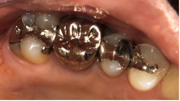 ダイレクトボンディング症例