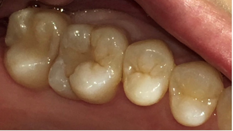 ダイレクトボンディング症例