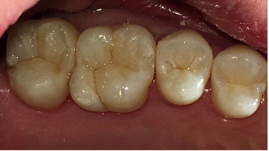 ダイレクトボンディング症例