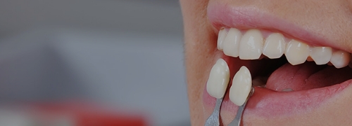 ホワイトニング